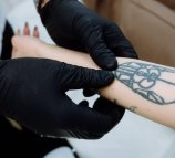 Студия лазерного удаления татуировок