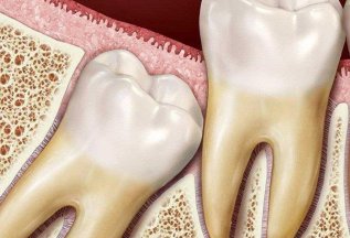 Удаление ретенированного зуба любой сложности