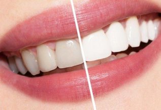Отбеливание зубов со скидкой 50%