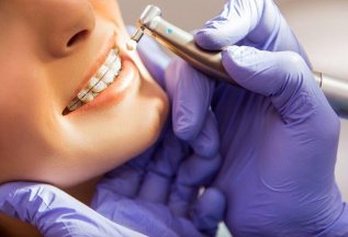 Профессиональная гигиена зубов при брекет системах за 5000Р