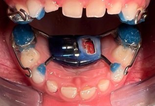 Ортодонтическое лечение детишек аппаратом Хаас до 12 лет!