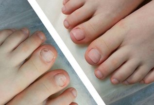 Протезирование и укрепление ногтевых пластин