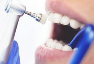 Профессиональная чистка зубов со скидкой 35%