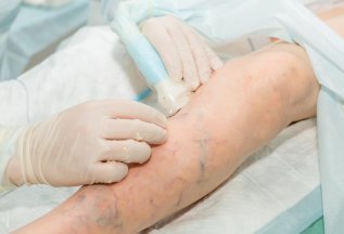 Лечение варикоза ног лазером за 1 день