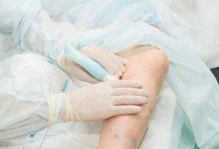 Скидка 15% на лечение варикоза ног в мае