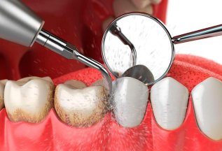 Профгигиена зубов со скидкой до 30%