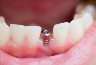 Протезирование зубов в стоматологии Ваш Дантист от 5300 ₽