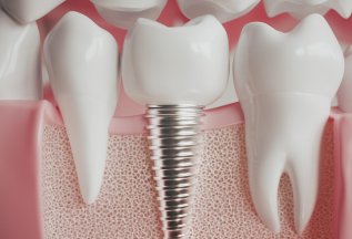 Имплантация зуба — 70 500 ₽