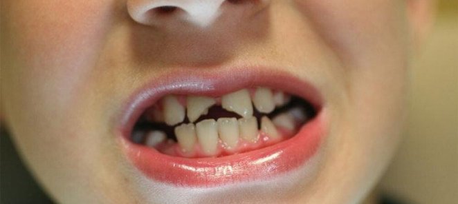Неотложная помощь при травме зуба у детей!!!