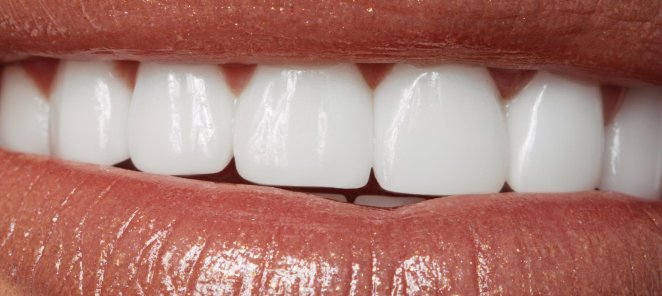Отбеливание зубов Amazing white — 13 300 ₽