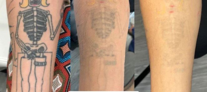 Лазерное удаление татуировок и татуажа -30%