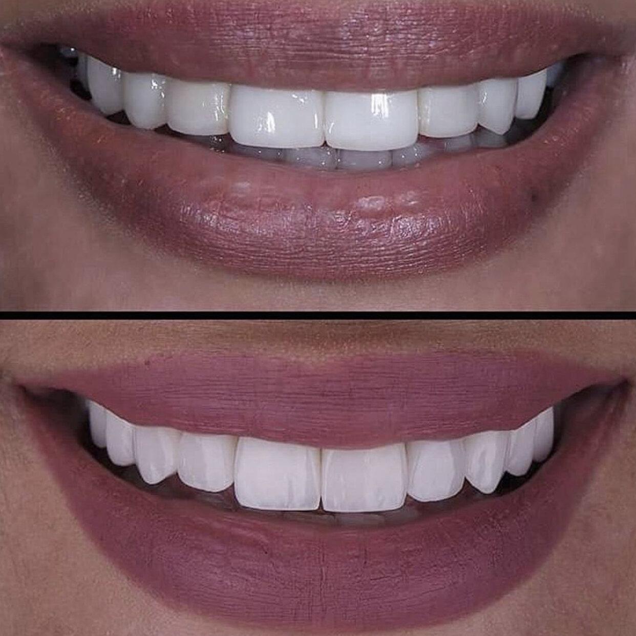 красивые зубы из металлокерамики фото