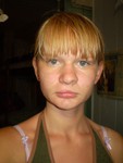 Расщелина верхней губы