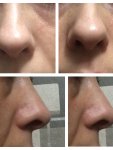 Ринопластика с изменением кончика носа