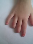 Протезы пальцев для ребенка