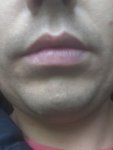 Деформация нижней губы