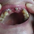 Какие протезы зубов поставить - съемные или несъемные?