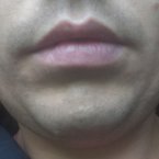 Деформация нижней губы