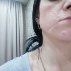 Возможно ли убрать шрам с лица? 