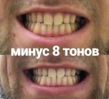 Студия косметического отбеливания зубов White&Smile