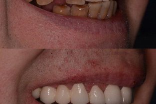 Venta dent