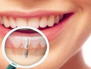  Какие бывают зубные импланты