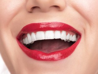 Красивая улыбка с винирами: что нужно знать об установке зубных накладок