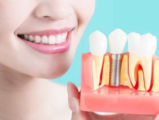 6 неочевидных фактов об имплантации зубов