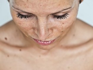 6 проверенных способов от пигментных пятен на лице