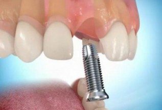 Установите зубной имплант в 3 раза дешевле за 1 посещение