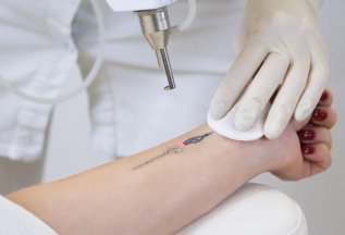 Удаление татуировки - 2-я процедура бесплатно! RedClinic
