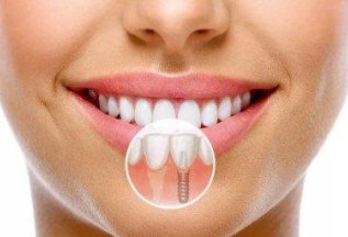 Имплантация зубов по сниженной цене!