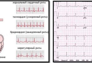 ЭКГ+расшифровка