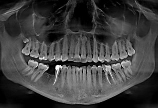 Скидка 5% на КТ исследование с 3D моделированием зубов*