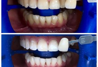 Отбеливание зубов ZOOM-4