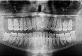 Панорамный снимок зубных рядов ( ОПТГ) со скидкой 40%