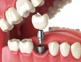 Имплантат Megagen Implant ( Южная Корея )
