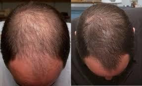 Мезотерапия кожи головы. Лечение выпадения волос. Алопеция.