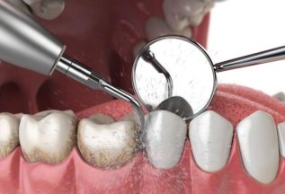 Комплекс профессиональной гигиены в стоматологии «Дентаюс»👍