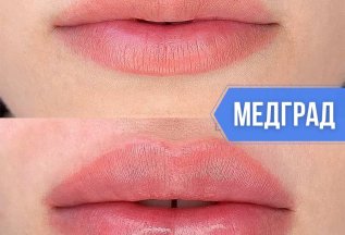 Увеличение/коррекция губ 6900р