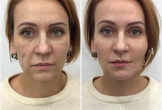Лифтинг Радиесс(Radiesse) 15.000тр (вместо 22000.р . 1.5мл)