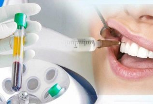 PRP в стоматологии