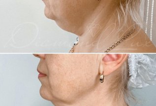 Липолитики - 1 процедура -4500₽