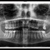 Ортопантомографический снимок 50% скидка