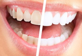 Клиническое отбеливание зубов 10 000 руб.