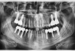 Имплантация зубов с Штрауманн - дёшево