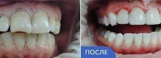 Акция. Восстановление зуба 8000 руб