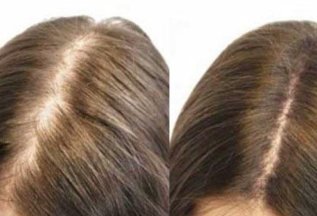 Лечение алопеции и восстановление роста волос