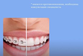 Диагностика и фиксация брекет систем