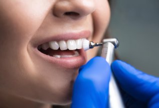 Профессиональная чистка зубов + осмотр и консультация